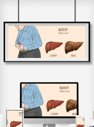 医疗器官脂肪肝科普医疗插画模板