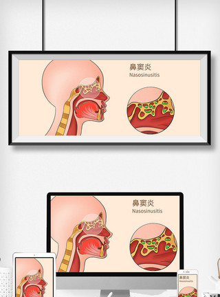 解剖的鼻窦炎科普医疗插画模板