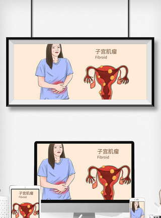 女性妇科子宫肌瘤科普医疗插画模板