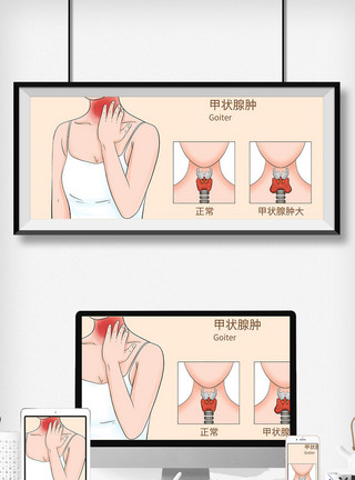 水母癌甲状腺疾病科普医疗插画模板
