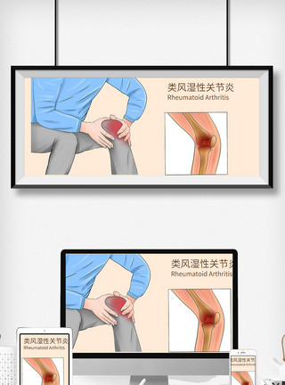 膝关节炎类风湿性关节炎科普医疗插画模板
