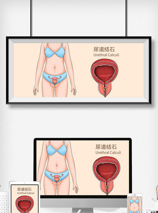 人体医学透视尿道结石科普医疗插画模板