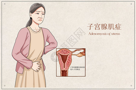 子宫腺肌症医疗插画图片