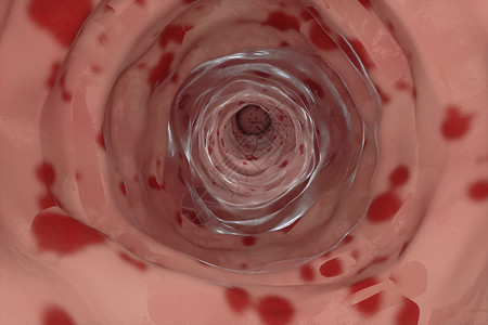 外膜阴道炎阴道模型设计图片
