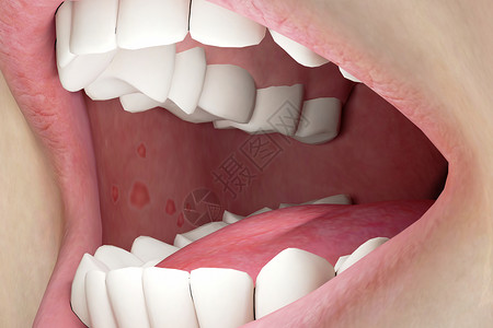 口腔解剖三维口腔溃疡场景设计图片