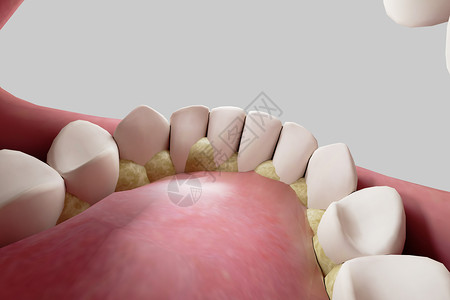 三维牙结石背景高清图片