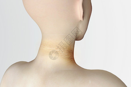 乳头状瘤三维黑棘皮病场景设计图片