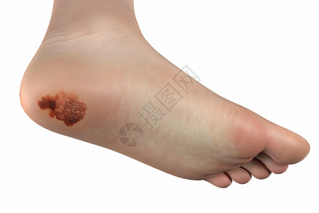 血脚印三维肢端黑色素瘤场景设计图片
