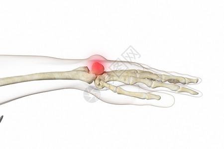 三维腱鞘囊肿场景高清图片