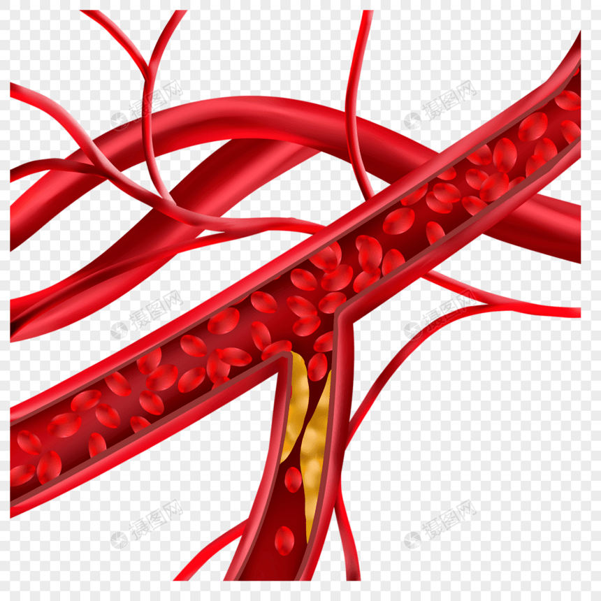 人体血管胆固醇堵塞动脉医学插图图片