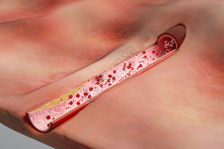 钙镁三维动脉血流受限场景设计图片