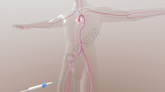 冠脉造影三维脑血管造影设计图片