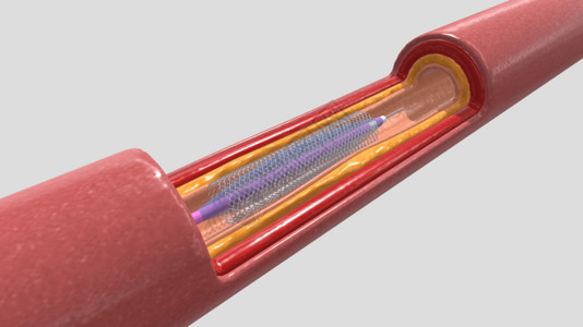 三维血管支架放置背景图片
