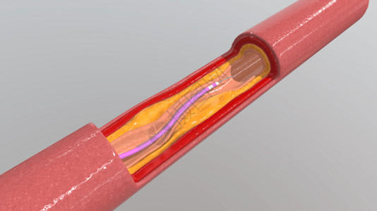 血管斑块三维血管支架放置过程设计图片