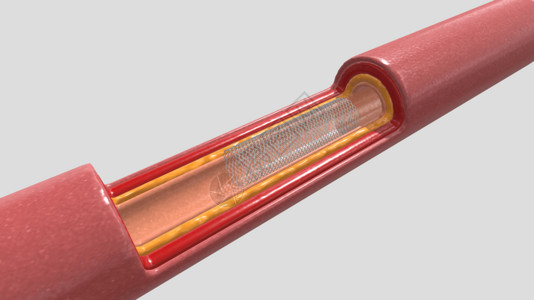 动脉粥样硬化斑块三维血管支架放置完成设计图片