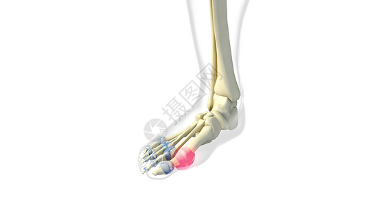 痛风发作大脚趾跖趾关节滑膜设计图片