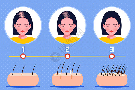 女性脱发植发过程图插画插画