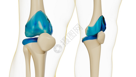 肥大性关节炎健康的膝关节-膝盖类风湿性关节炎设计图片