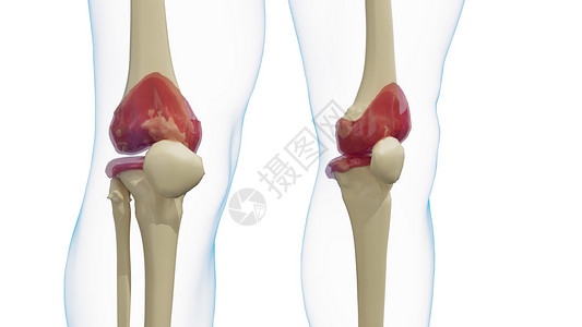 肥大性关节炎发炎的膝关节-膝盖类风湿性关节炎设计图片