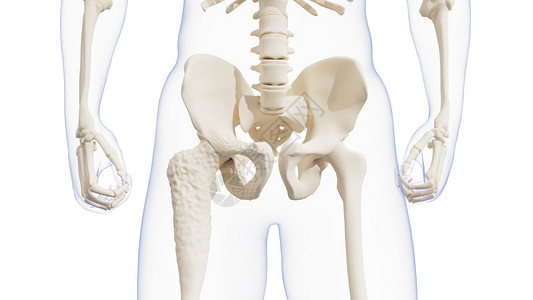 佩吉特骨病骨盆变形高清图片