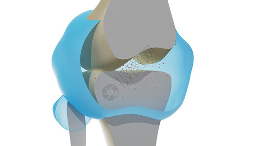 骨骼动画组织水平炎症(膝盖累风湿性关节炎）（动画）设计图片