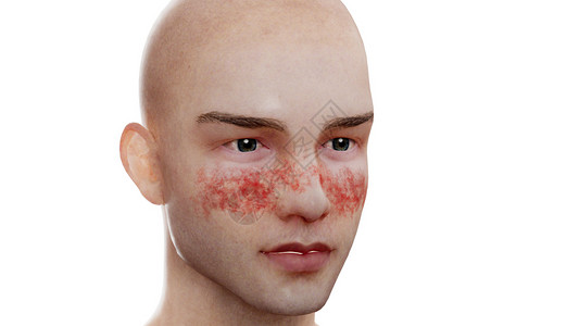 红斑狼疮：马拉尔皮疹高清图片
