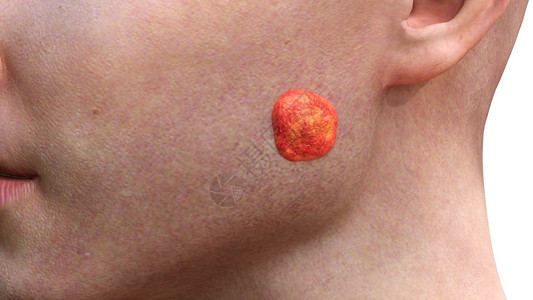 面部基底细胞癌二期背景图片