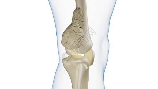 股骨骨肉瘤3D人体骨肉瘤高清图片