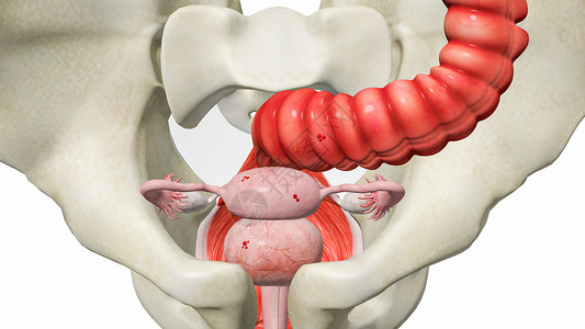 右肱桡肌子宫内膜异位症设计图片