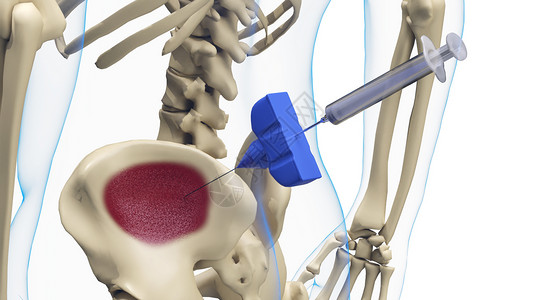肌肉减少骨髓抽吸设计图片