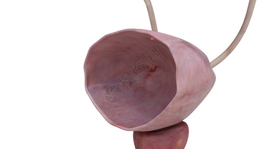 肾盆输尿管膀胱癌0期肿瘤设计图片