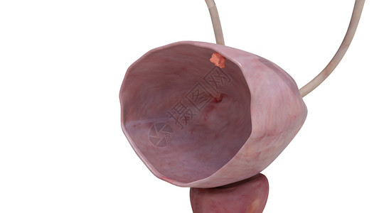 皮粉色膀胱癌1期肿瘤设计图片