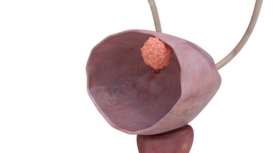 泌尿皮细胞膀胱癌2期肿瘤设计图片