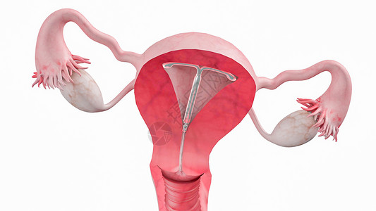 宫内节育器右侧子宫骶韧带高清图片