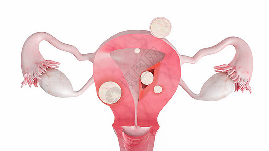 子宫肌瘤右侧子宫骶韧带高清图片