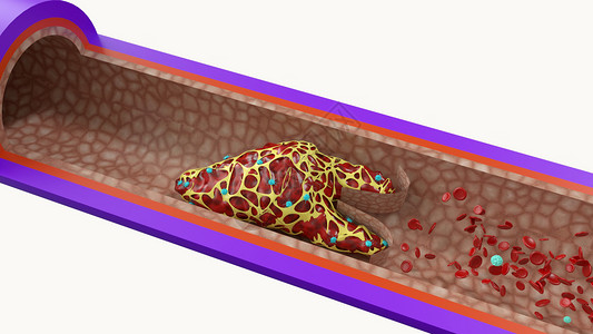 静脉血块建模血块高清图片