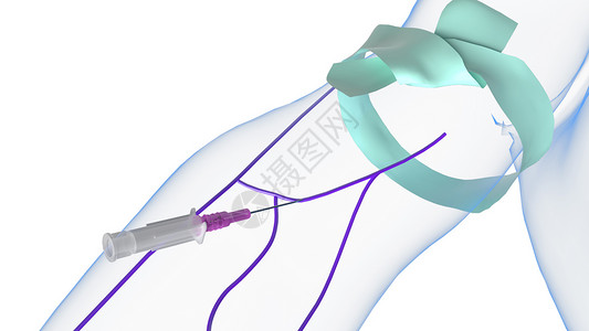 静脉导管静脉注射放下套管设计图片