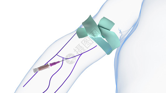 肘的静脉注射插管推进设计图片