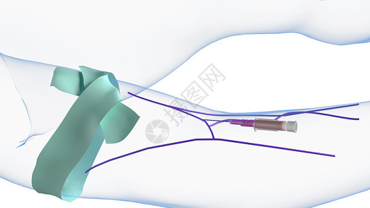 静脉导管静脉注射第一次闪回设计图片