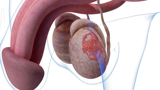 睾丸扭转IB阶段睾丸癌设计图片