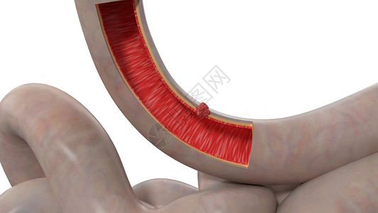 肠黏膜十二指肠癌症第2期设计图片
