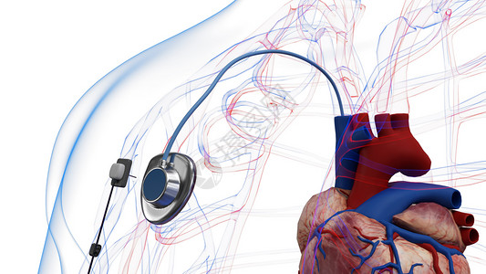 心脏导管静脉输液端口设计图片