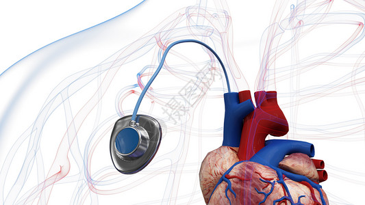 心脏导管静脉输液端口设计图片