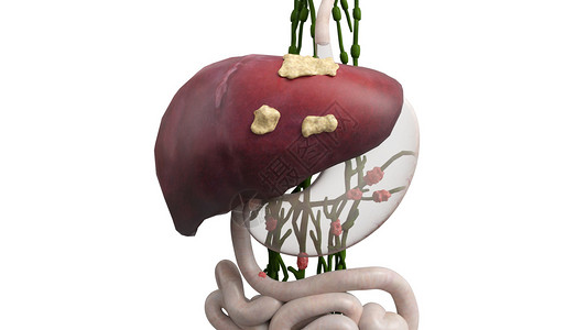 肠黏膜十二指肠癌症第4期设计图片