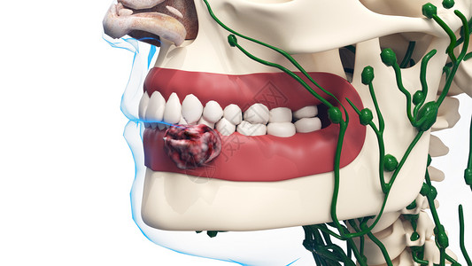 骨骼牙齿第二期口腔癌设计图片
