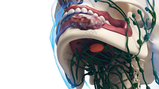 人体口腔第三期口腔癌设计图片