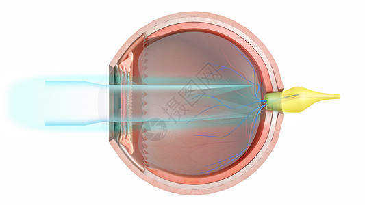 右视网膜中央动脉散光设计图片
