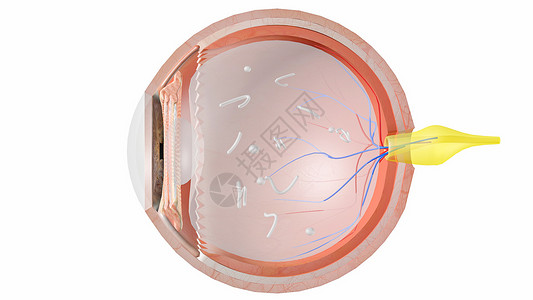 右视网膜中央动脉漂浮物设计图片