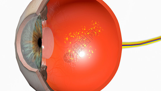 右视网膜干性黄斑变性设计图片
