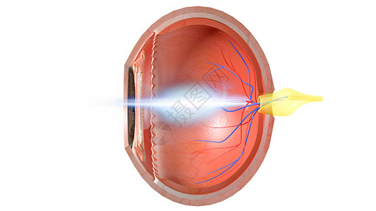 视网膜中央静脉远视设计图片